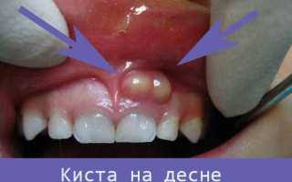 Белая точка на десне у ребенка 1302 0